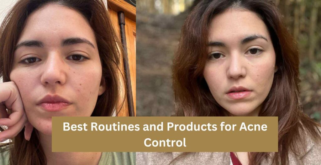 Best Routines and Products for Acne Control