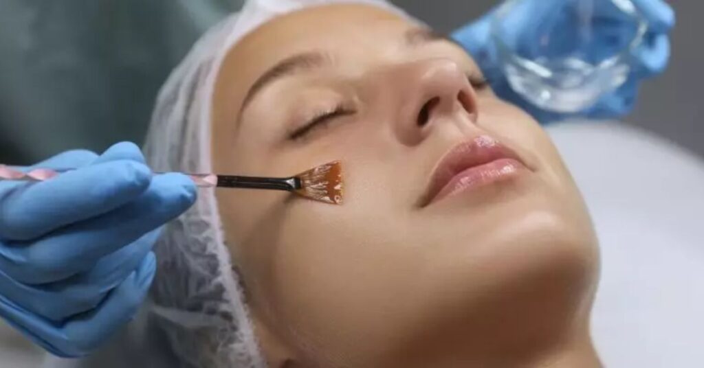 Chemical Peels