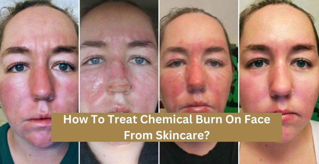 How To Treat Chemical Burn On Face From Skincare