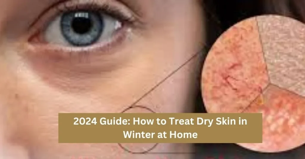 How to Treat Dry Skin in Winter at Home