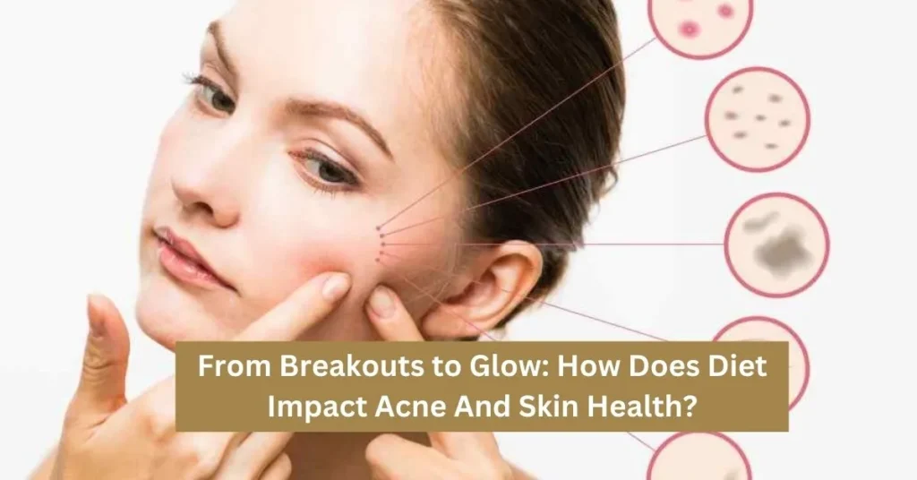 How Does Diet Impact Acne And Skin Health