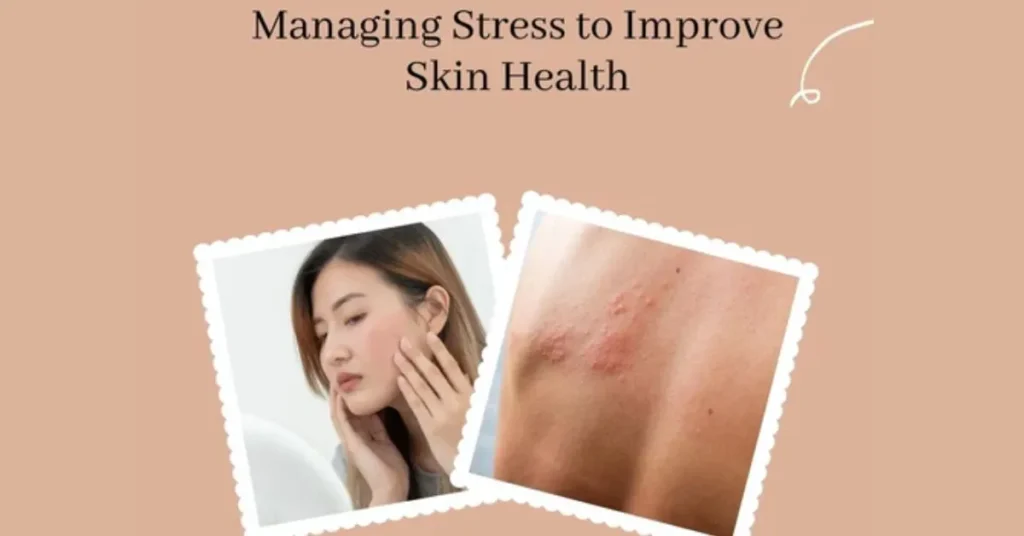 Managing Stress to Improve Skin Health