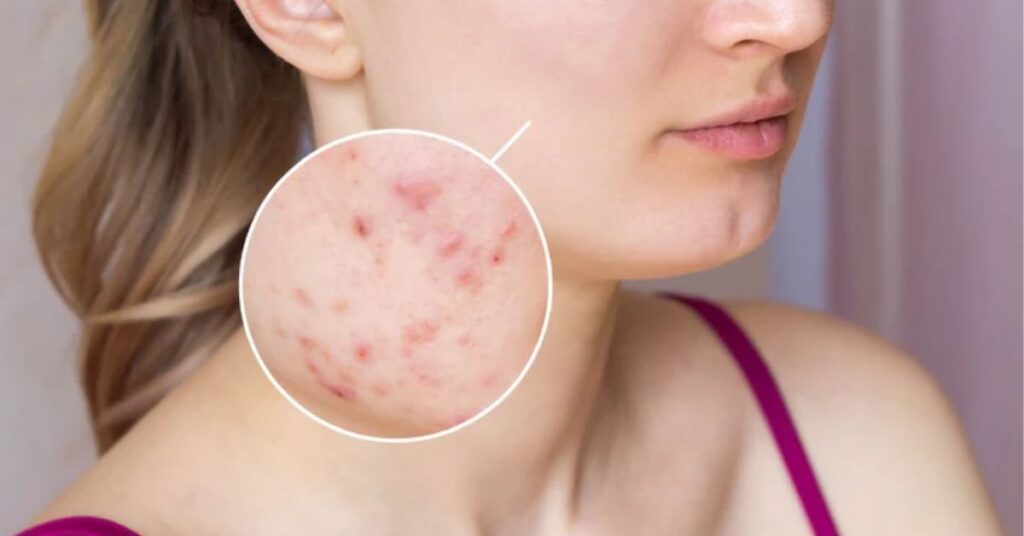 Signs You’re Over-Exfoliating Sensitive Skin